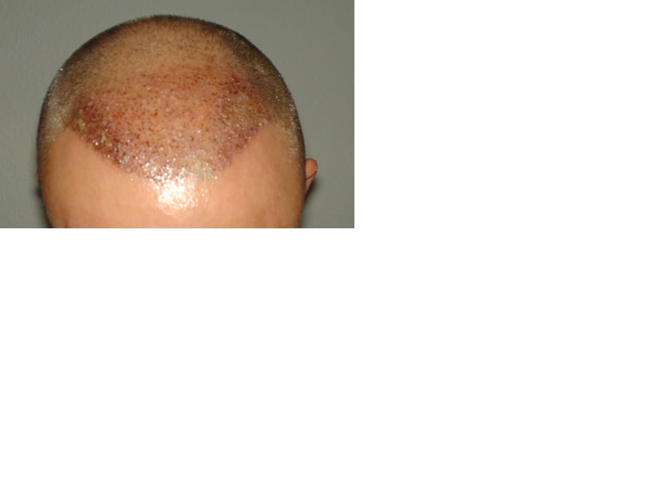 http://www.alopezie.de/diskussion/transplant/uploads/1_Front_2_Tage_nach_OP.JPG