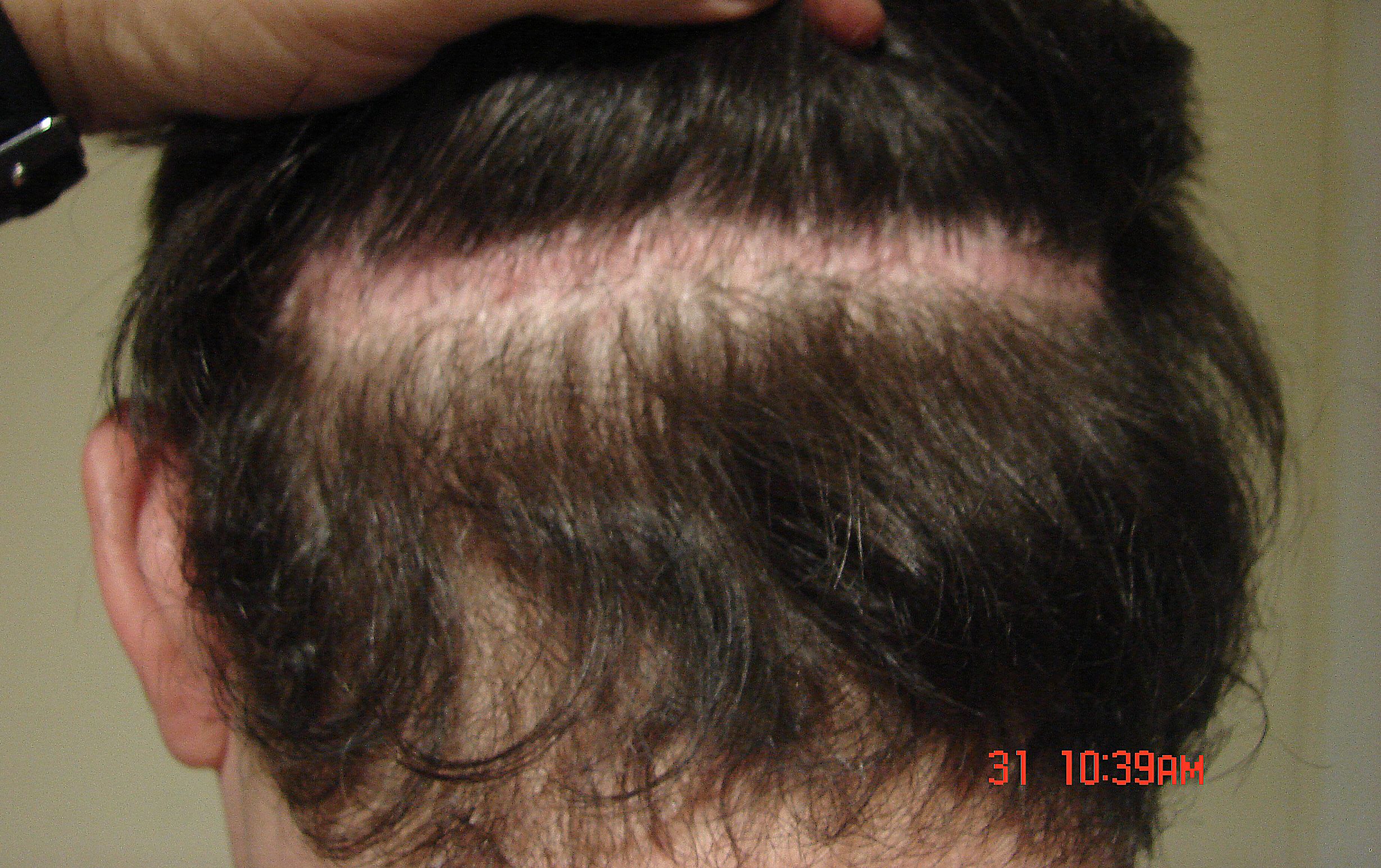 http://alopezie.de/foren/transplant/index.php/fa/1075/