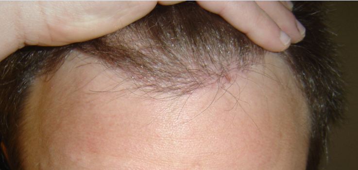 http://alopezie.de/foren/transplant/index.php/fa/10836/