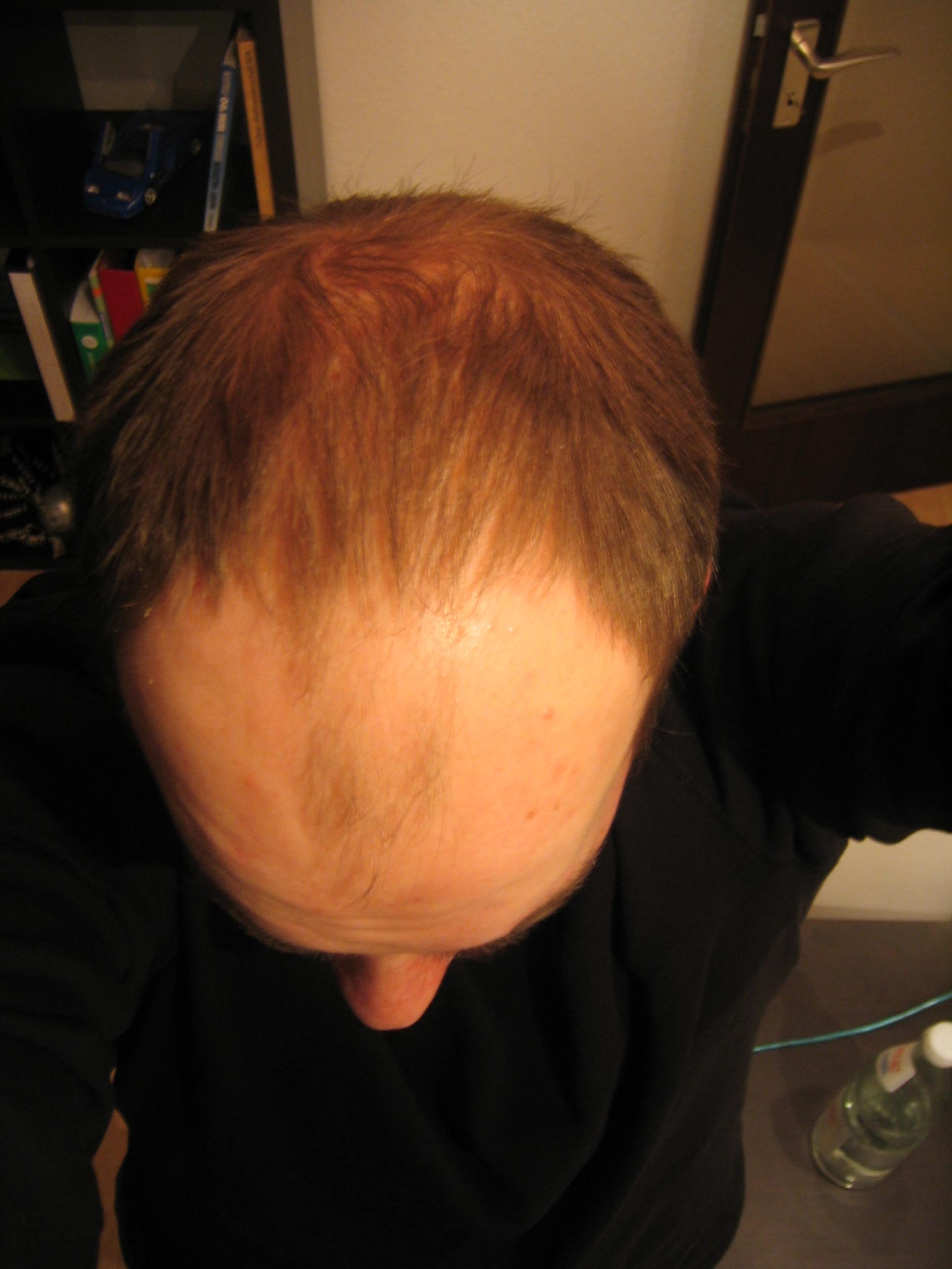 http://alopezie.de/foren/transplant/index.php/fa/1740/