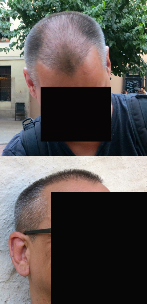 http://www.alopezie.de/foren/transplant/index.php/fa/25094/