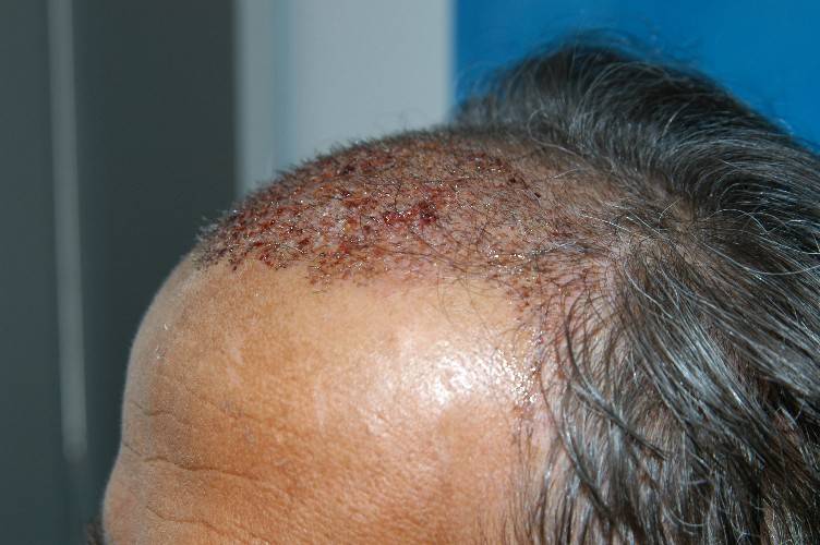 http://alopezie.de/foren/transplant/index.php/fa/30/0/
