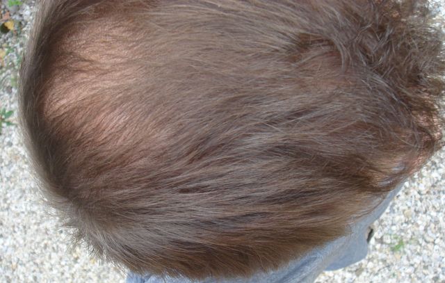 http://alopezie.de/foren/transplant/index.php/fa/3220/0/