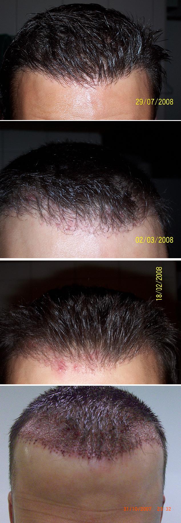 http://alopezie.de/foren/transplant/index.php/fa/3280/0/