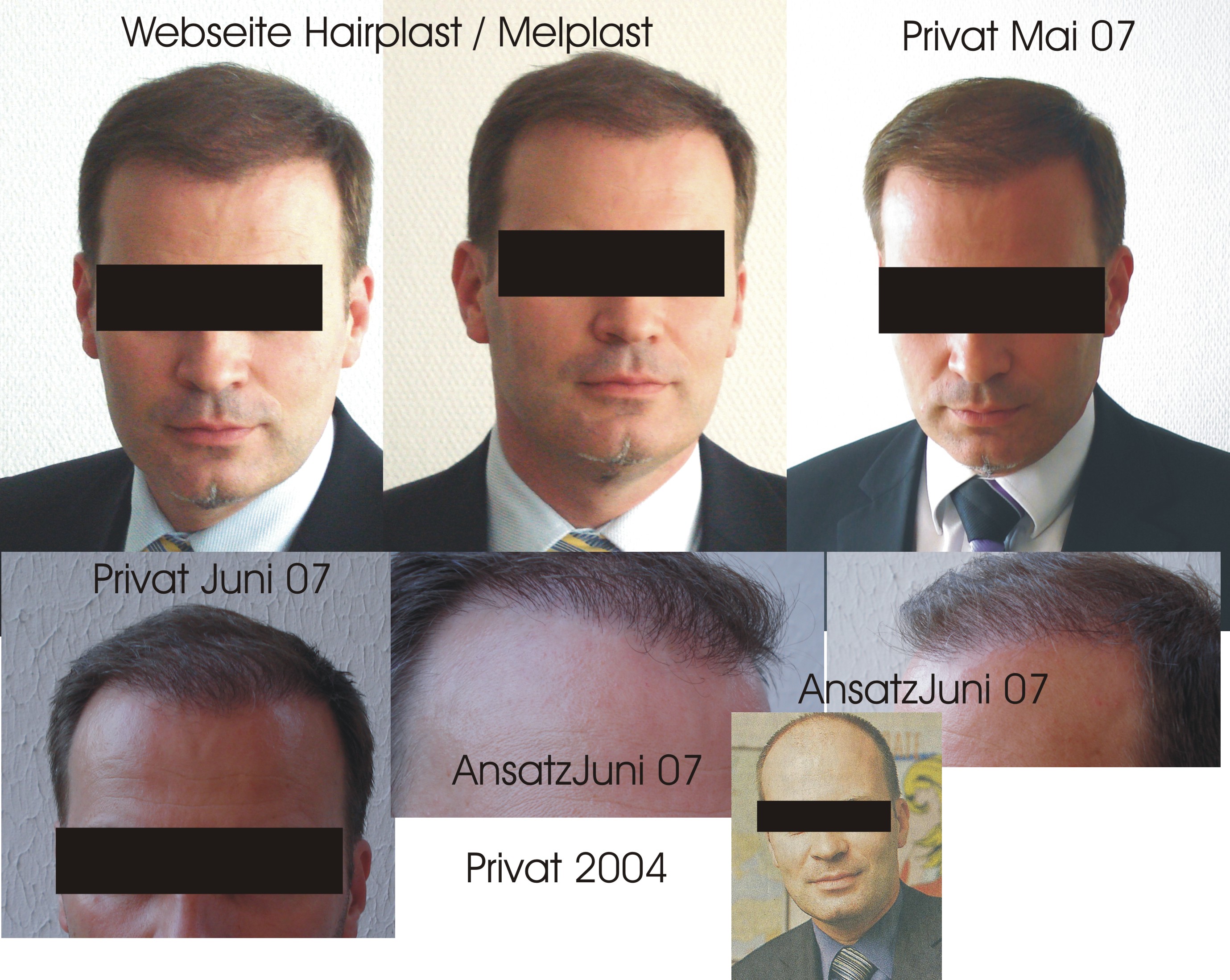 http://alopezie.de/foren/transplant/index.php/fa/461/