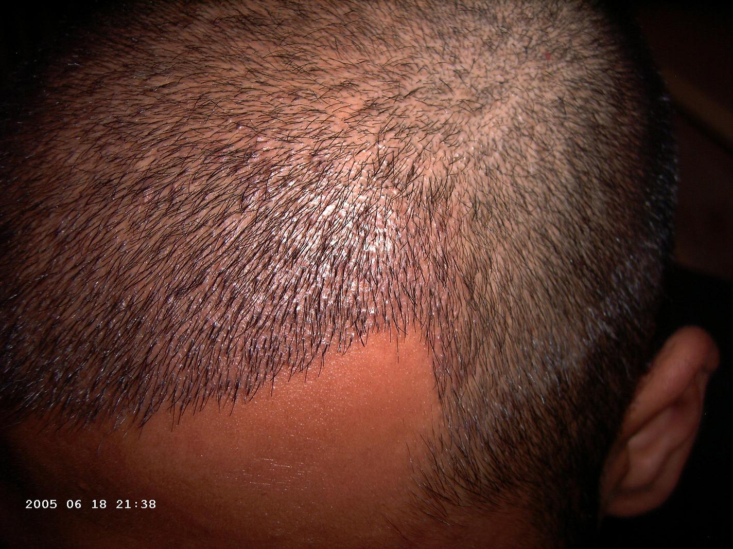 http://alopezie.de/foren/transplant/index.php/fa/601/0/