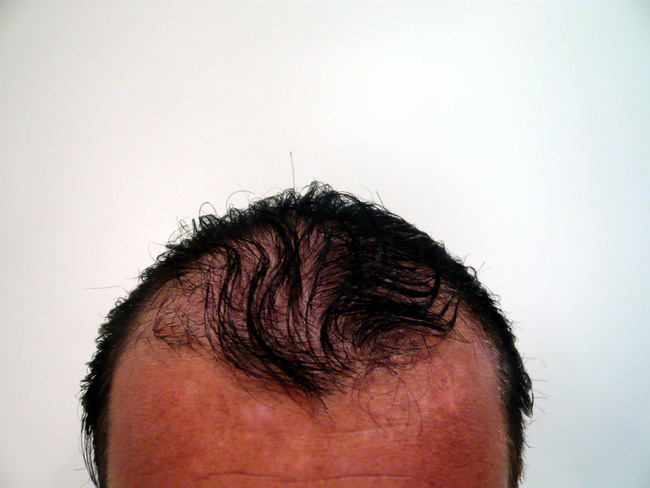 http://alopezie.de/foren/transplant/index.php/fa/7832/