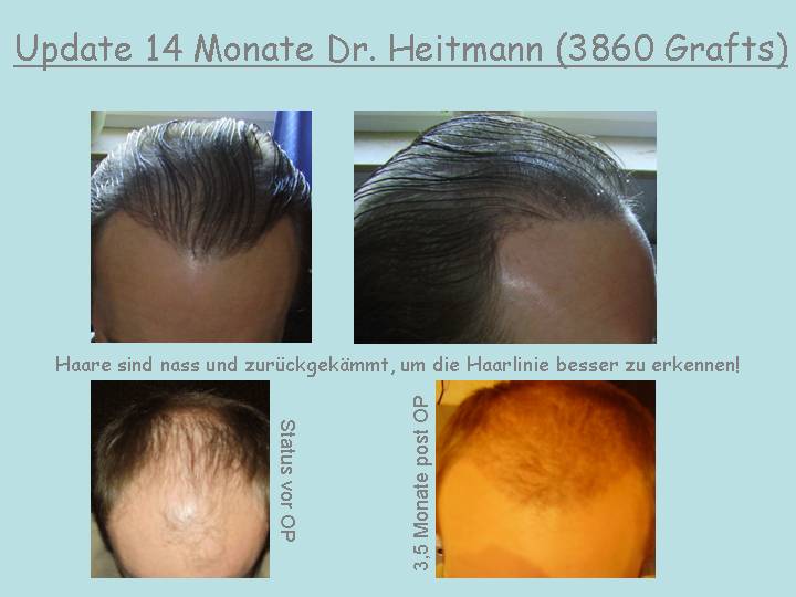 http://alopezie.de/foren/transplant/index.php/fa/830/0/