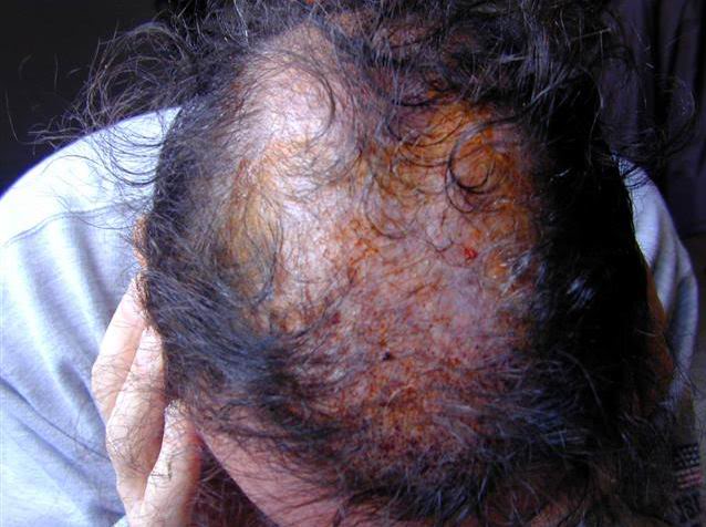 http://alopezie.de/foren/transplant/index.php/fa/8977/