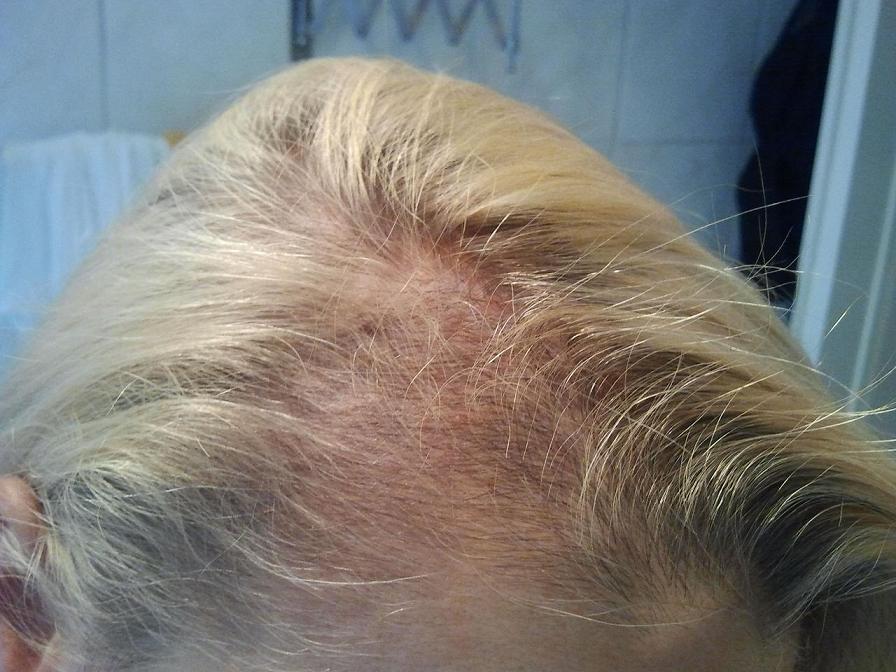 Forum Haarausfall Frauen Forum Frauen Bilder Von Meinem Haarausfall Ghe Seiten