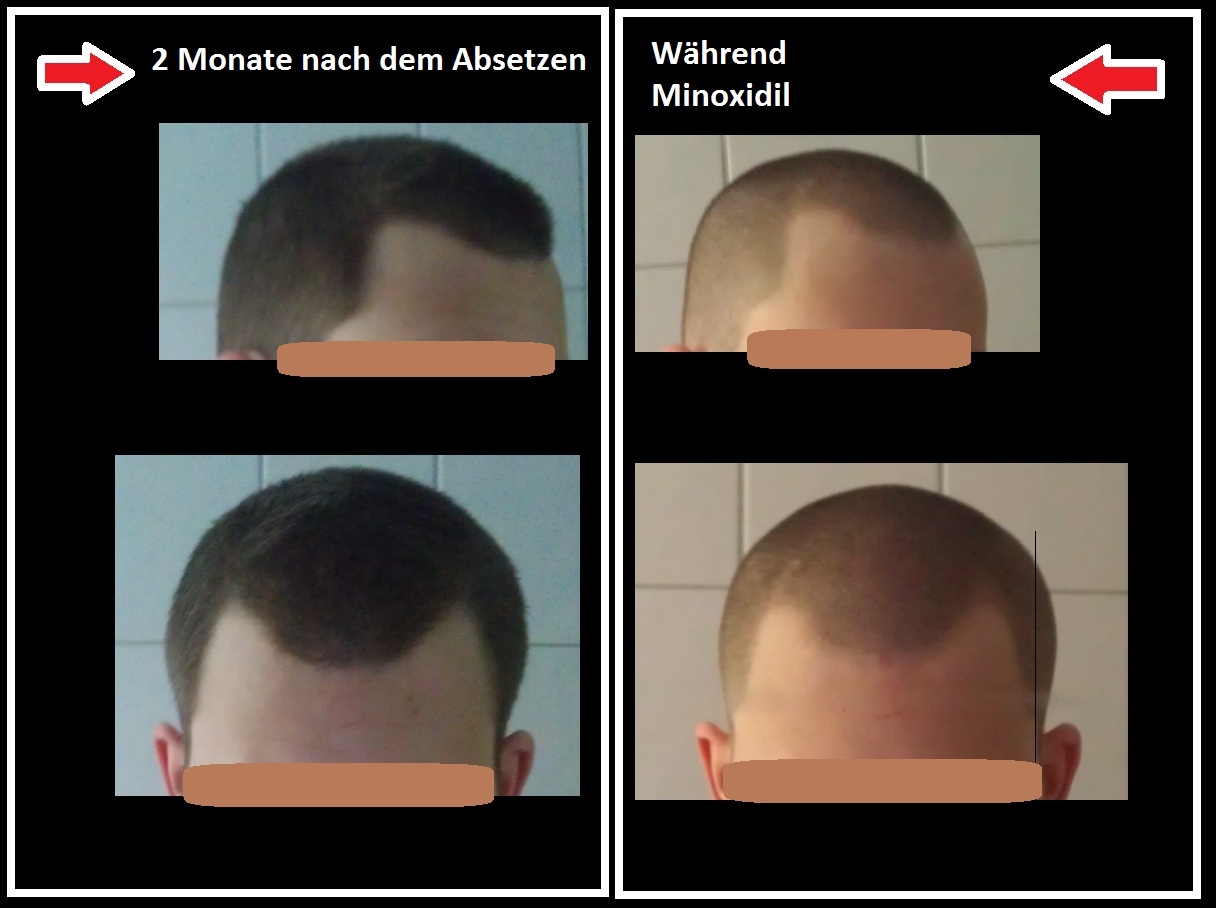 43++ Ell cranell vorher nachher bilder , Haarausfall Allgemeines Forum Minoxidil » Minoxidil abgesetzt