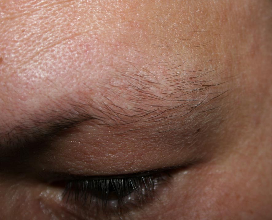 Haarausfall - Allgemeines Forum : Minoxidil » Augenbrauen Verlust durch  Minox?